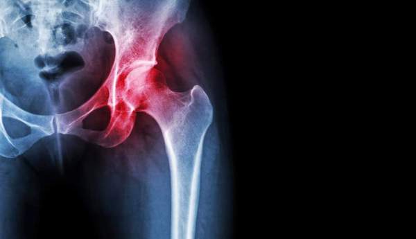Coxartrosi o Artrosi dell'anca