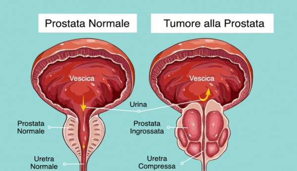Tumore alla Prostata - Campanelli d'allarme